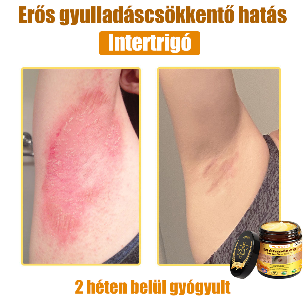 (🎁2025-ös Újévi Akció🎁 50% Kedvezmény🎁)PLTOWE® Méhméreg All-in-One krém US Bőrgyógyászatilag elfogadott